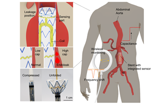 HYU Research Team Develops Wireless Sensor for Real-Time Detection of Life-Threatening Blood Leakage After Stent Surgery